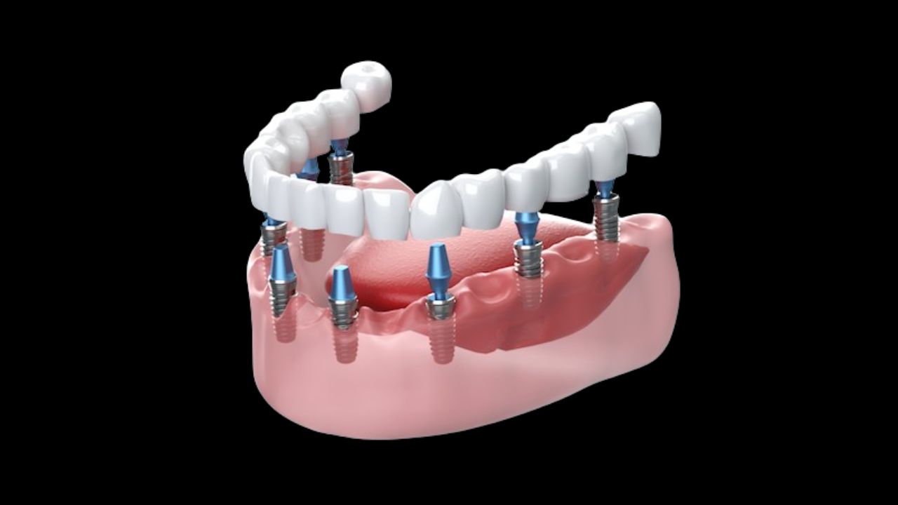 What Do Dental Implants Look Like