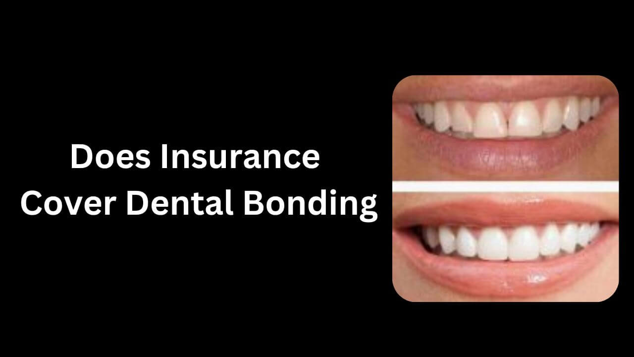 Does Insurance Cover Dental Bonding