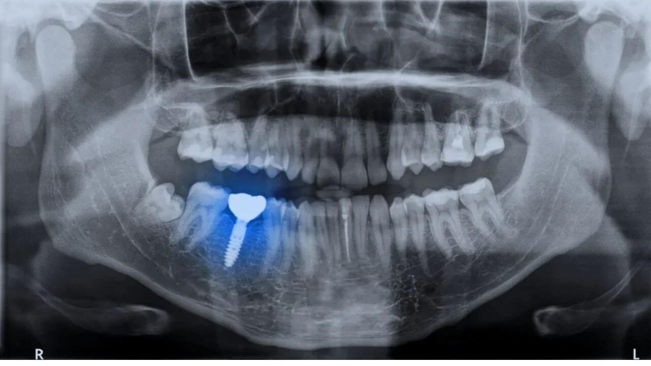 Can You Get an MRI with a Dental Implant